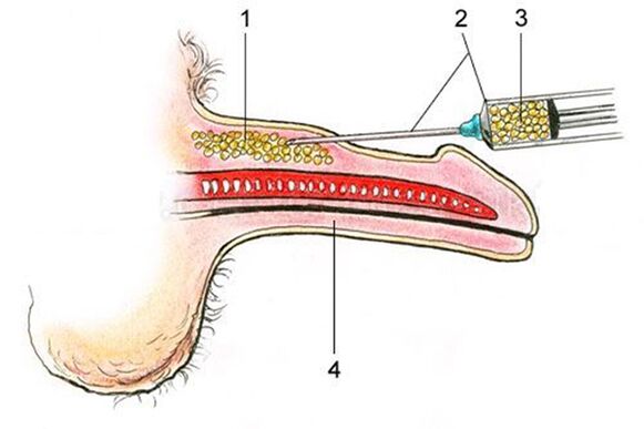 Липофилинг - уношење масног ткива у осовину пениса